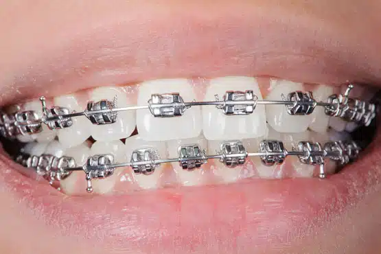 Rubber Bands for Braces  Hidden Valley Orthodontics